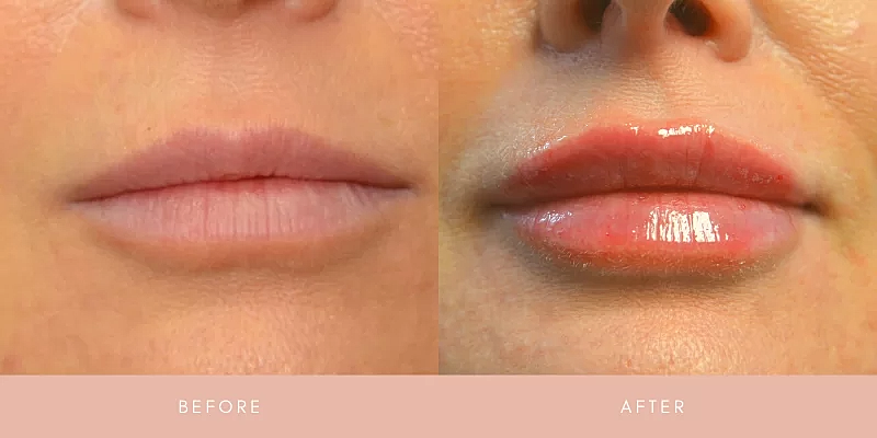 Dermal Fillers Before & After