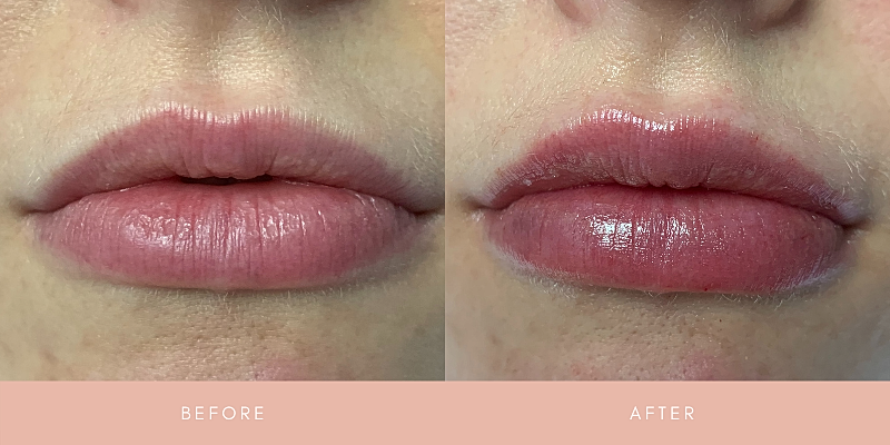 Dermal Fillers Before & After
