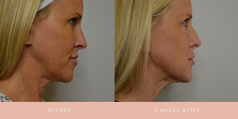 Thread Lift Before & After