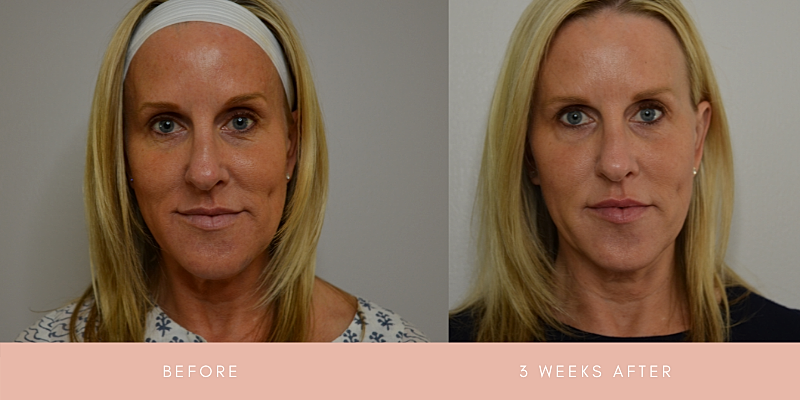 Thread Lift Before & After