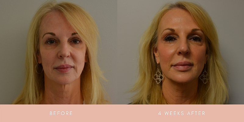 Thread Lift Before & After