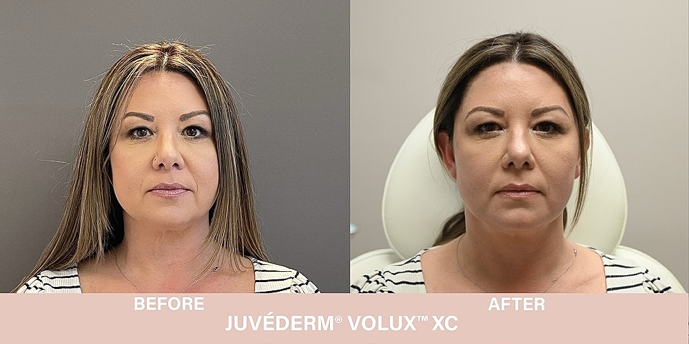 Volux Before & After