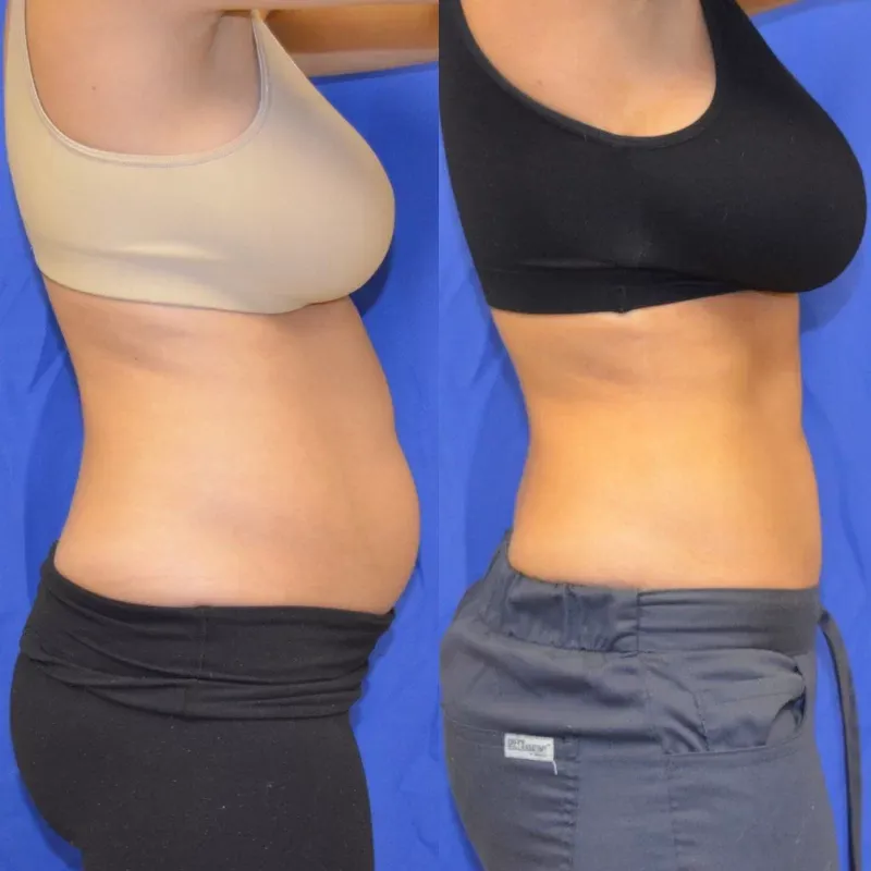 Coolsculpting Before & After