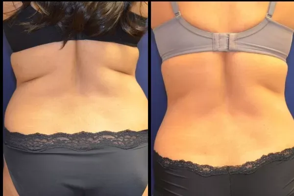 Coolsculpting Before & After