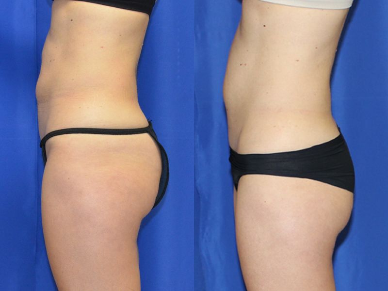 Coolsculpting Before & After