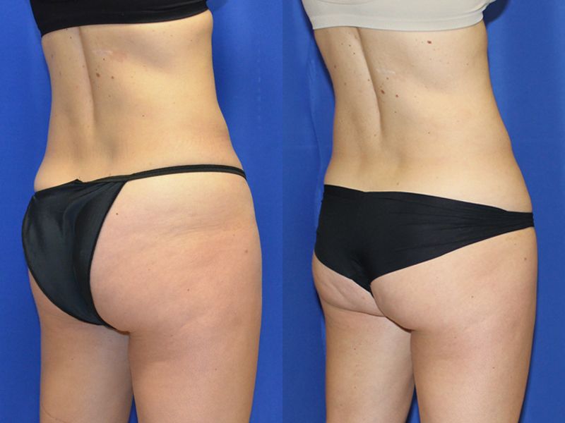 Coolsculpting Before & After