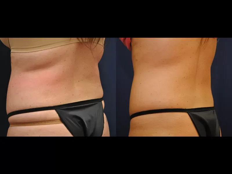 Coolsculpting Before & After