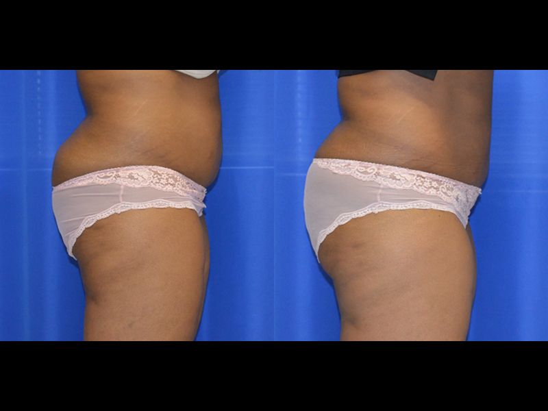 Coolsculpting Before & After