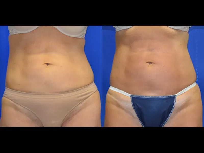 Coolsculpting Before & After