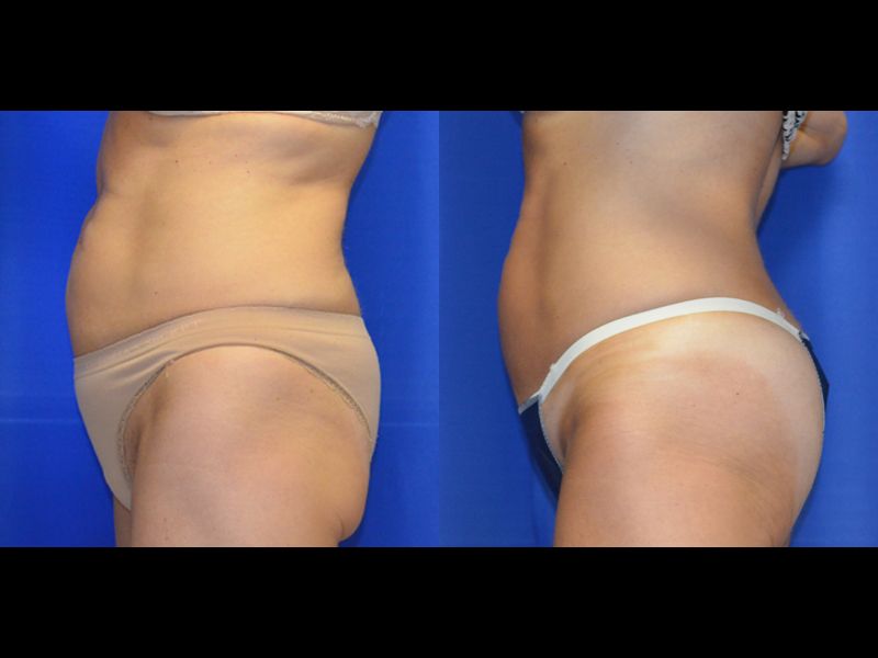 Coolsculpting Before & After