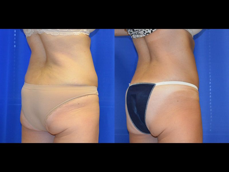 Coolsculpting Before & After