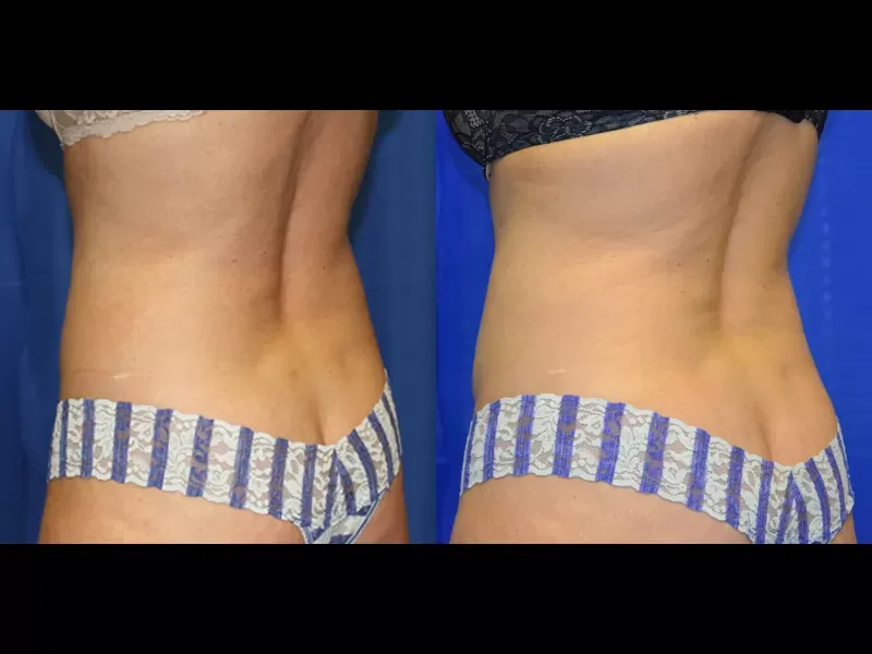 Coolsculpting Before & After
