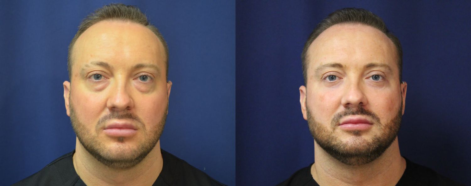 Blepharoplasty Before & After