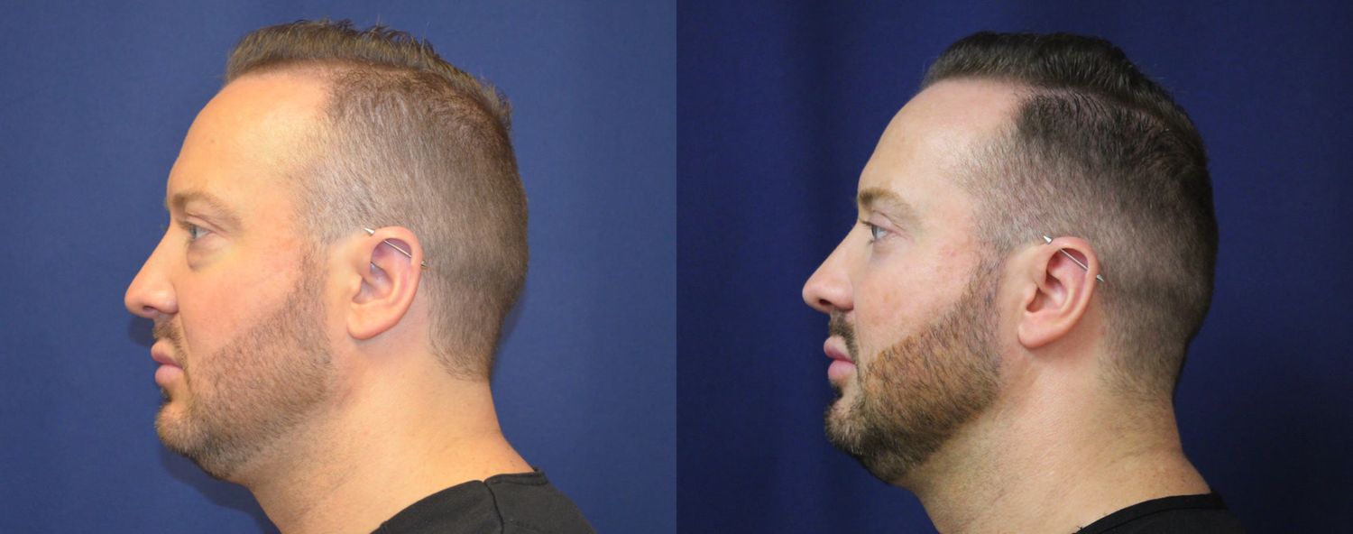 Blepharoplasty Before & After