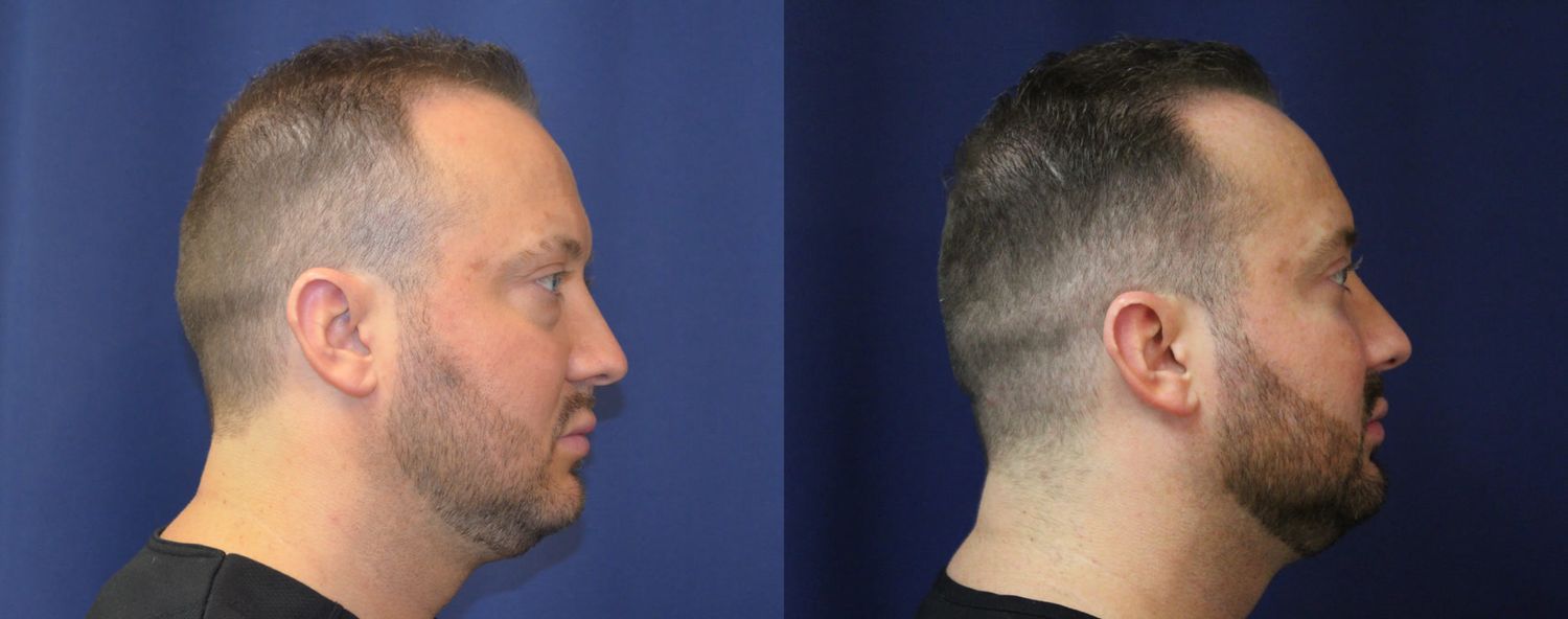 Blepharoplasty Before & After