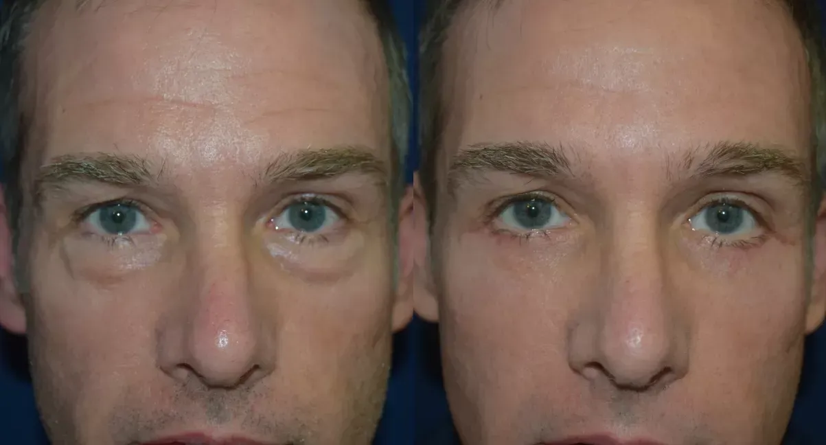 Blepharoplasty Before & After