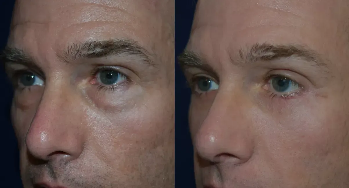 Blepharoplasty Before & After