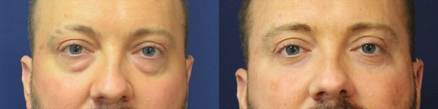 Blepharoplasty Before & After
