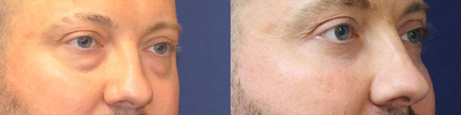 Blepharoplasty Before & After