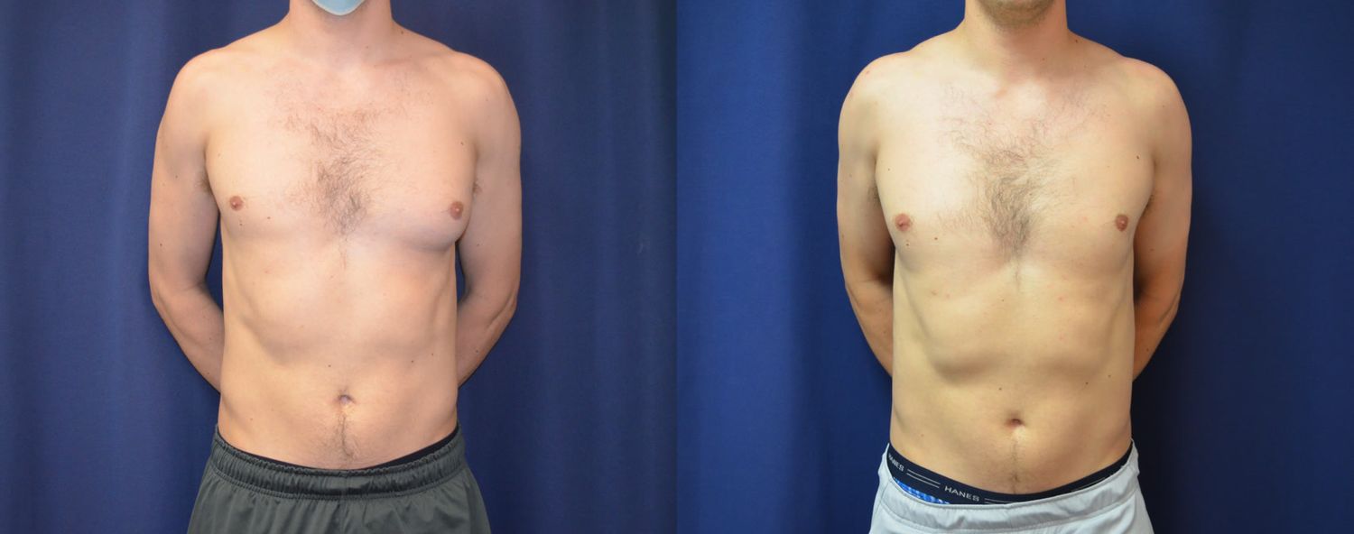 Gynecomastia Before & After