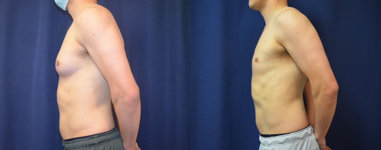 Gynecomastia Before & After