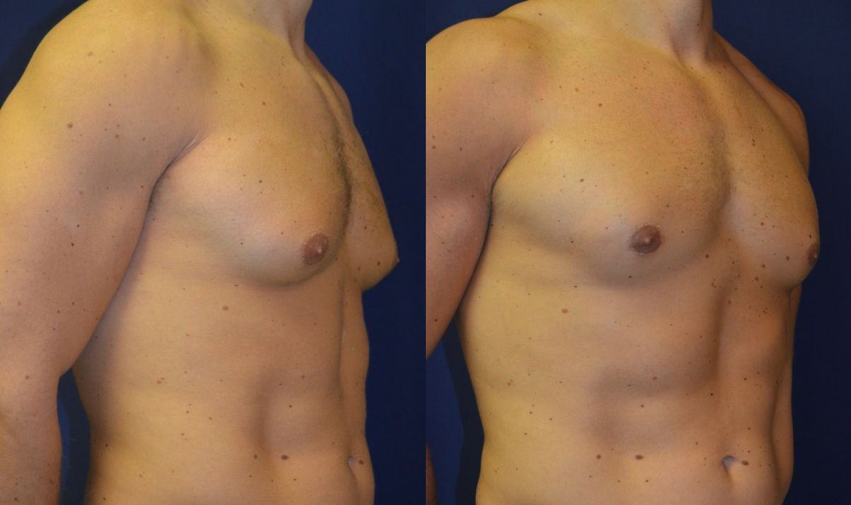 Gynecomastia Before & After