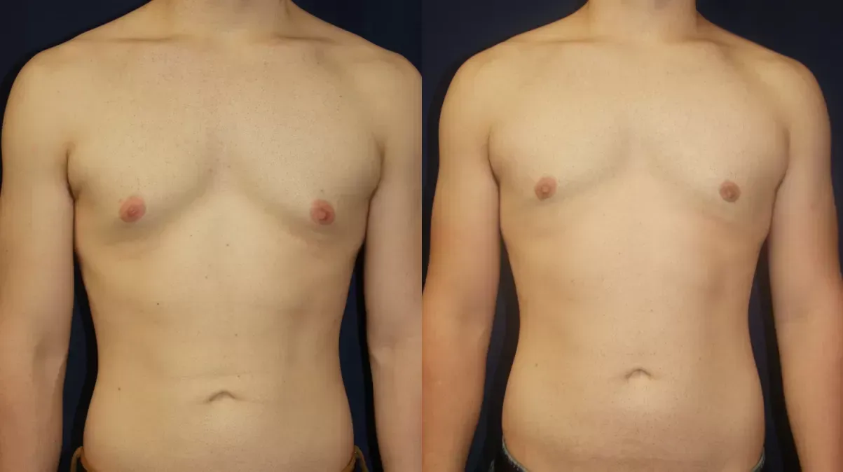 Gynecomastia Before & After