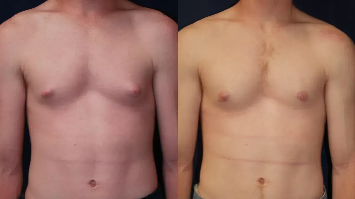 Gynecomastia Before & After