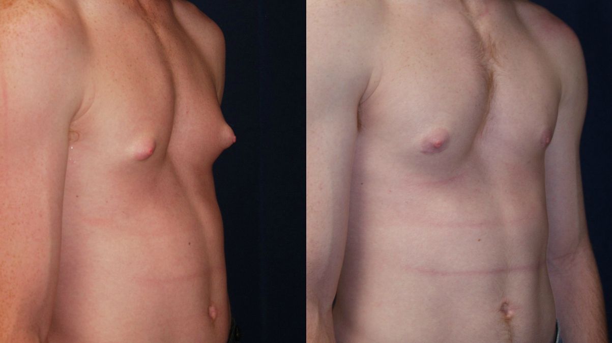 Gynecomastia Before & After