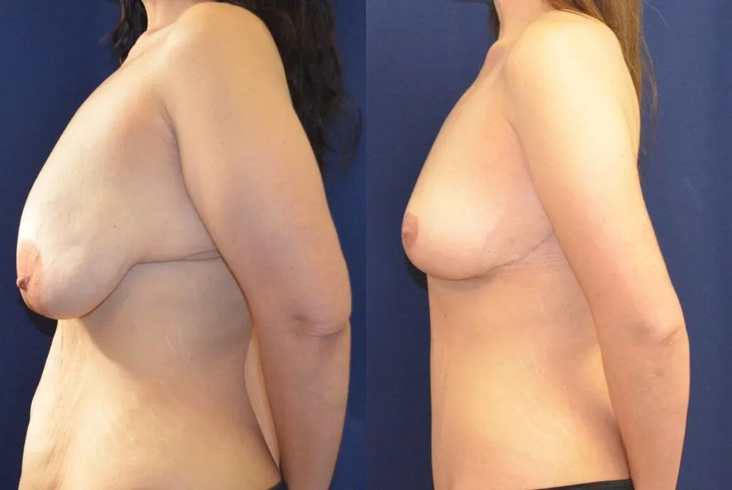 Brachioplasty Before & After
