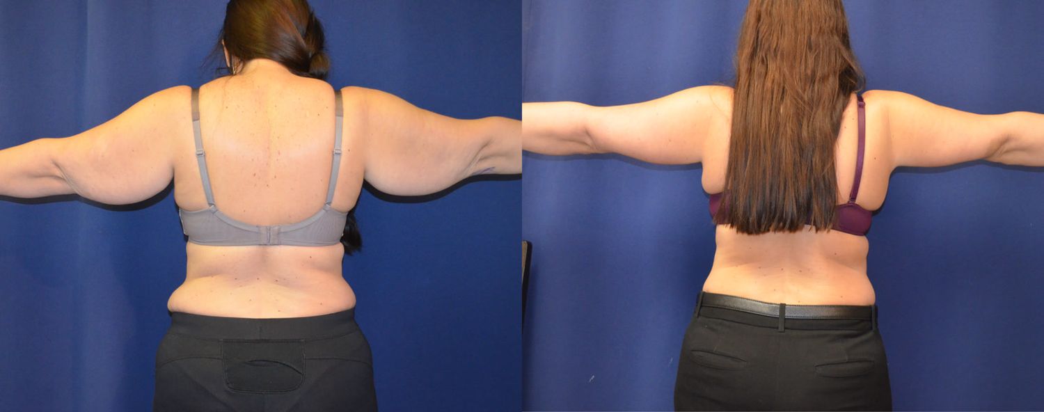 Brachioplasty Before & After