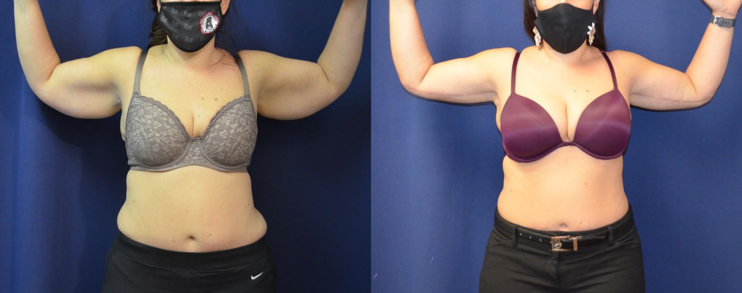 Brachioplasty Before & After