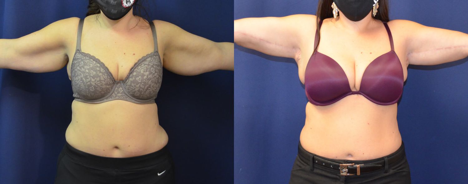 Brachioplasty Before & After