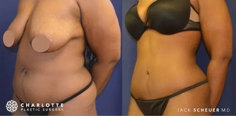 Mommy Makeover Before & After