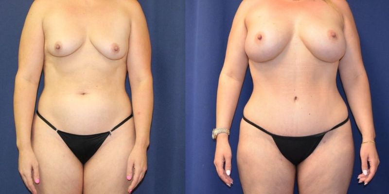 Mommy Makeover Before & After