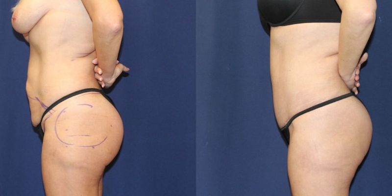 Mommy Makeover Before & After