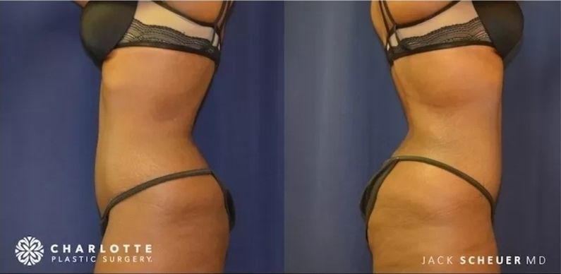 Mommy Makeover Before & After