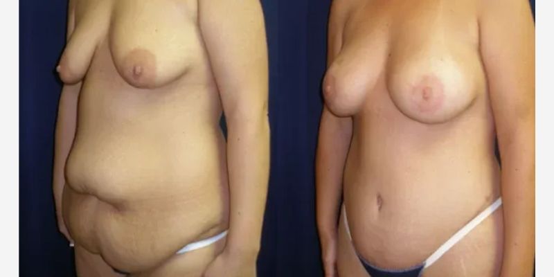 Mommy Makeover Before & After