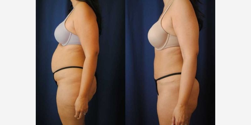 Mommy Makeover Before & After