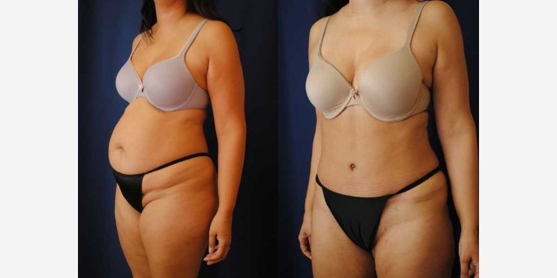 Mommy Makeover Before & After