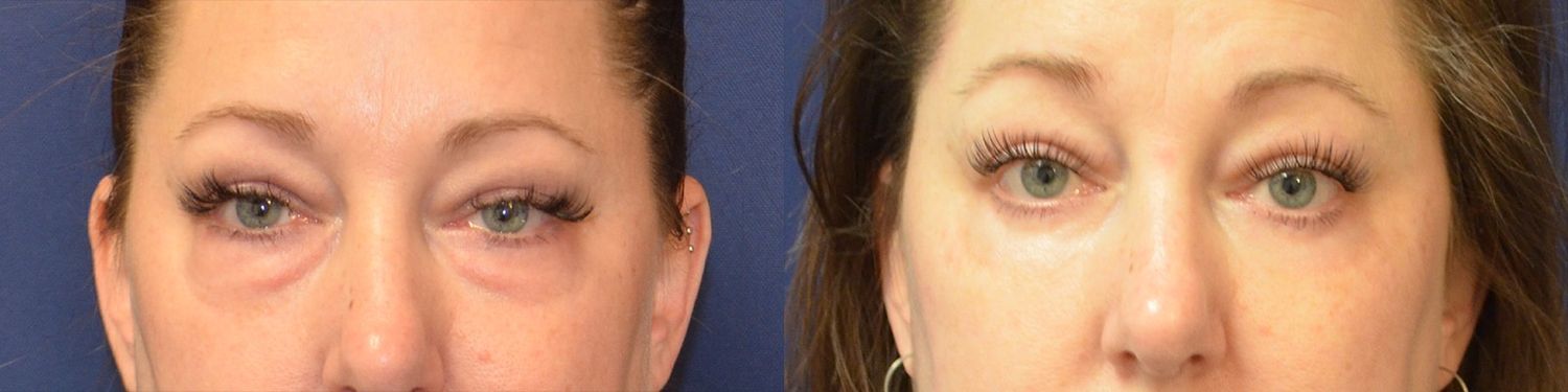 Blepharoplasty Before & After