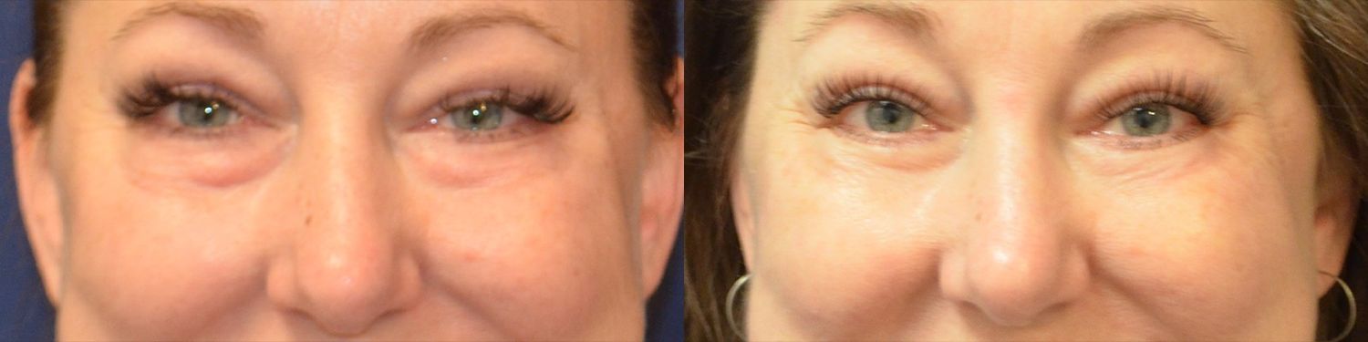 Blepharoplasty Before & After