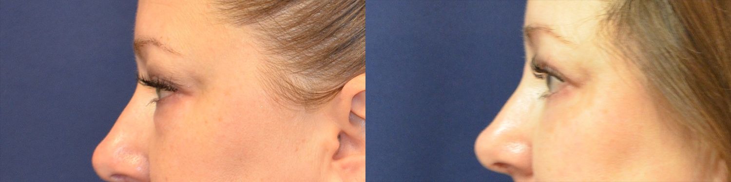 Blepharoplasty Before & After