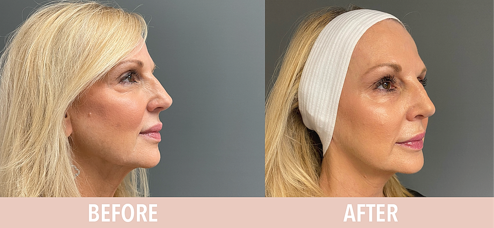 Botox Before & After