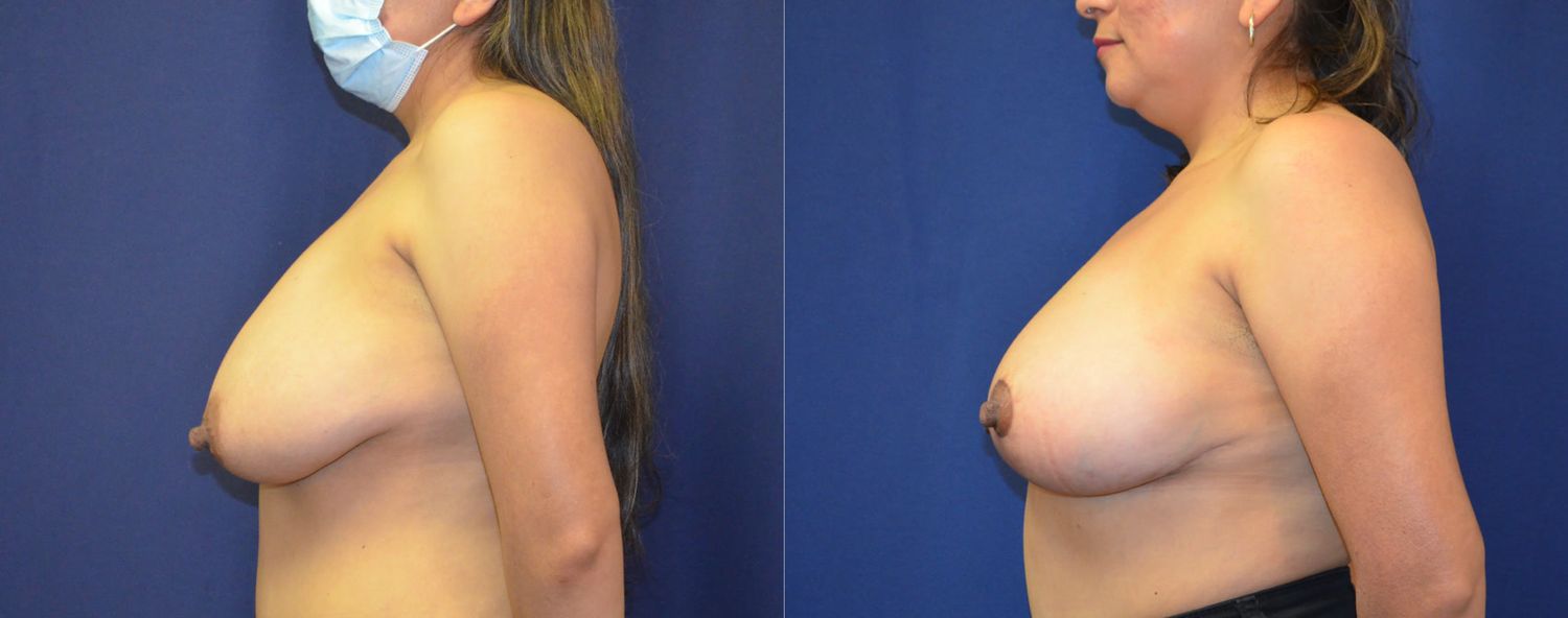 Breast Lift Before & After