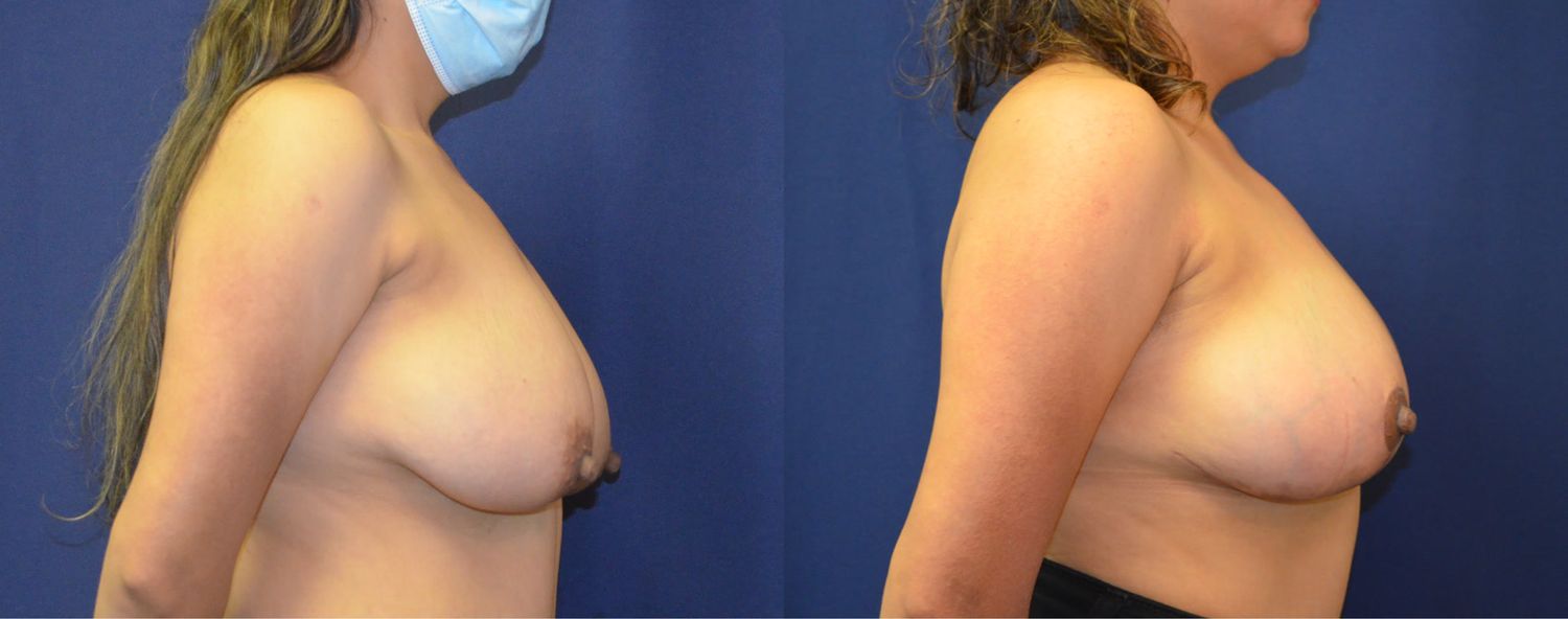 Breast Lift Before & After