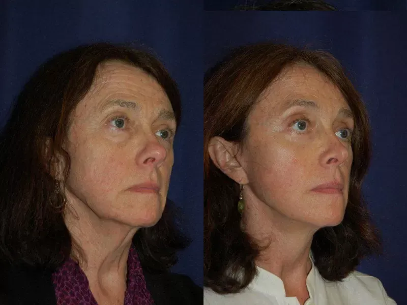 Forehead Lift Before & After