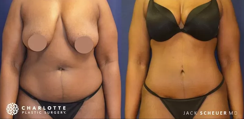 Body Contouring Before & After