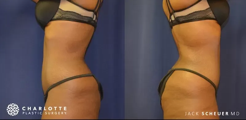 Body Contouring Before & After