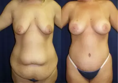 Body Contouring Before & After